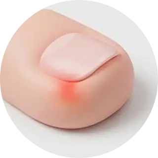 내성발톱 케이스 1 내성발톱 케이스 1
