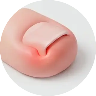 내성발톱 케이스 2 내성발톱 케이스 2