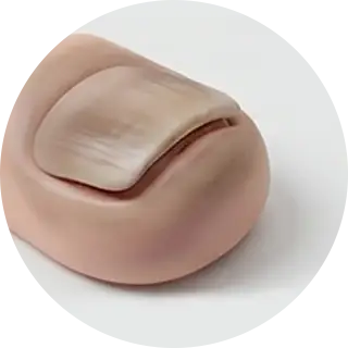 무좀 발톱 케이스 3 무좀 발톱 케이스 3